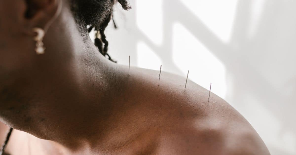 Acupuncture for Shoulder Tension and Emotional Balance - Integrated Chiropractic Acupuncture needles placed along the shoulder to support anxiety and stress relief